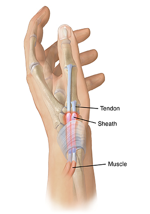 Side view of hand showing inflamed tendons in base of thumb.