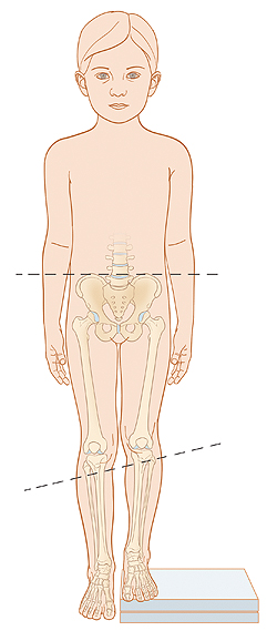 Contorno de un niño en el que pueden verse los huesos de la pelvis y de las piernas. La pierna izquierda es más corta que la pierna derecha. La línea punteada muestra que las caderas están niveladas. Otra línea punteada muestra que las rodillas se encuentra a diferente altura.