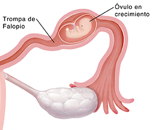 Primer plano de la sección transversal de una trompa de Falopio donde puede verse un embrión en crecimiento en un caso de embarazo ectópico.