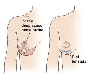 Dos imágenes de un pecho femenino que ilustran el seno derecho, comparando su posición antes y después de la mastopexia, los sitios de las incisiones y la zona de tejido extirpado.
