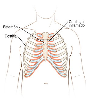 Contorno del torso que muestra la caja torácica. Las costillas están unidas por cartílago al esternón que se encuentra en el centro del pecho. El cartílago está inflamado.