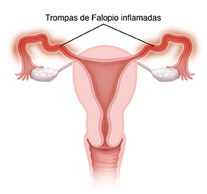 Corte transversal visto de frente de la vagina, el útero, las trompas de Falopio y los ovarios. Las trompas de Falopio están inflamadas.