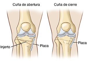 Vista frontal de las estructuras óseas de dos rodillas que muestran la osteotomía en cuña de cierre y en cuña de abertura.