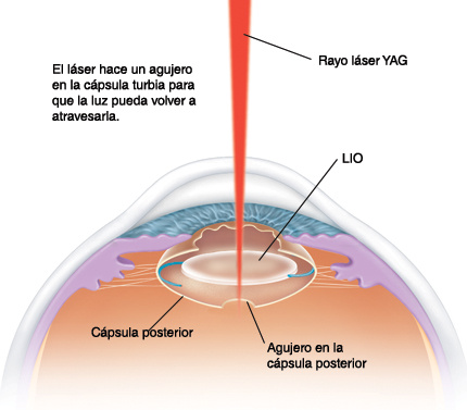 Corte transversal visto de lado de un ojo en donde se ve un haz de rayo láser YAG que entra en la córnea transparente y atraviesa la pupila para llegar al lente intraocular (LIO) dentro de la cápsula posterior borrosa. El láser hace una abertura en la cápsula borrosa que permite que la luz pase nuevamente.