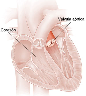 Corte transversal del corazón que muestra una válvula aórtica con insuficiencia. 