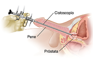 Vista lateral de una pelvis masculina donde puede verse una resección transuretral de la próstata.