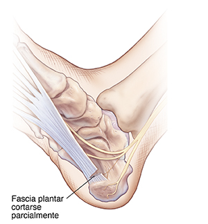 Vista inferior de un pie donde se observa la fascia plantar parcialmente cortada cerca del talón.