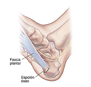 Vista inferior de un pie donde se observa espolón óseo en el talón cerca de la fascia plantar.