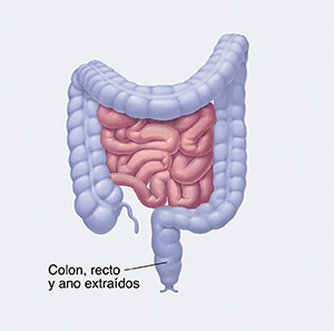 Vista frontal de los intestinos donde se resalta el colon, el recto y el ano para ver la sección a extirpar.