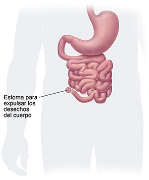 Vista frontal del tracto digestivo inferior donde se observa la extracción del colon y el recto, y la estoma de una ileostomía permanente.