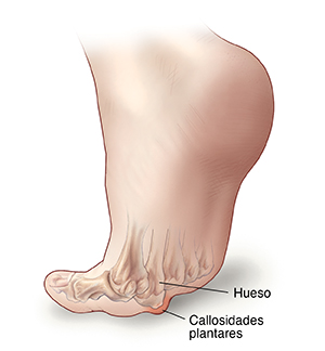 Vista inferior del pie flexionado donde se observan callosidades plantares en el metatarso del pie.
