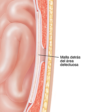 Corte transversal de una pared abdominal donde puede verse la malla detrás de la hernia.