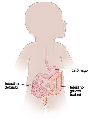 Contorno de un bebé que muestra malrotación intestinal.