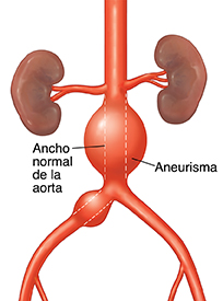 Vista frontal de la aorta abdominal con aneurismas. La línea de puntos muestra el ancho normal de la aorta.