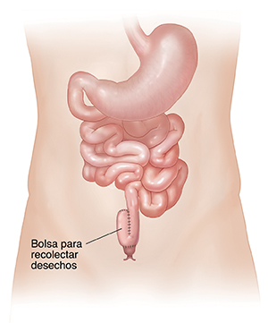 Vista frontal de los intestinos que muestra la bolsa intestinal para recolectar los residuos.