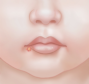 Primer plano de una boca en donde se ve una ampolla en el labio inferior.