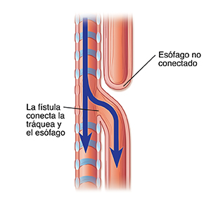 Vista lateral de una tráquea y un esófago donde puede verse una combinación de fístula y artresia.