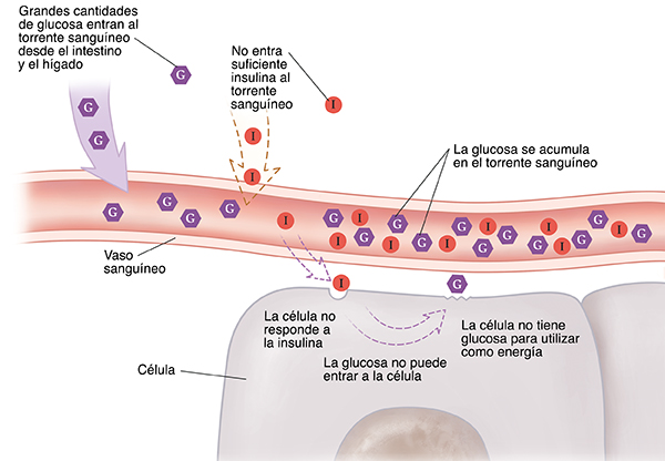Primer plano de un corte transversal de un vaso sanguíneo cerca de células donde se observa un caso de diabetes tipo 2. La célula no responde a la insulina. La glucosa no puede entrar en las células y se acumula en el torrente sanguíneo.