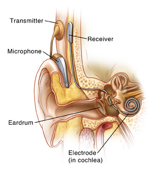 Front view of the inner ear with a cochlear implant in place.