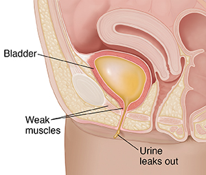 Closeup cross section of female pelvis showing bladder with incontinence leaking urine.