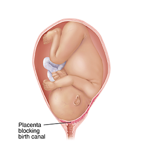 Front view of full-term fetus in uterus in pelvic bones with head down. Placenta is blocking birth canal, showing placental previa.