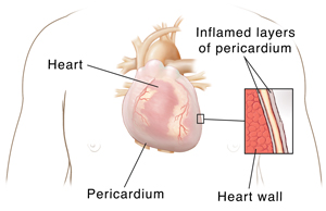 Outline of human chest showing heart and pericardium. Closeup cross section showing two layers of inflamed pericardium with fluid in between them on top of heart wall.