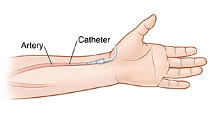 Palm of hand and forearm showing arterial line in radial artery.