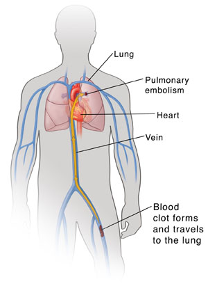 Contorno de un torso masculino donde pueden verse el corazón, los pulmones y las venas principales. Puede verse un coágulo sanguíneo en la vena de la pierna con una flecha que indica que está viajando por la vena hacia el pulmón.