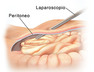 Vista lateral de corte transversal de la parte baja del abdomen donde puede verse un laparoscopio que entra al cuerpo a través del peritoneo.