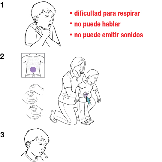 3 pasos para dar presiones abdominales a un niño como primeros auxilios por atragantamiento.