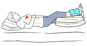 Mujer acostada con una pierna elevada por encima del nivel del corazón. Tiene un vendaje y una compresa de hielo en el tobillo.