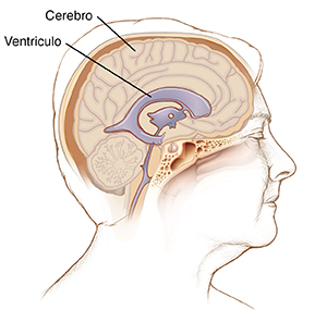 Vista lateral de la cabeza de una mujer donde se ven el cerebro y los ventrículos.