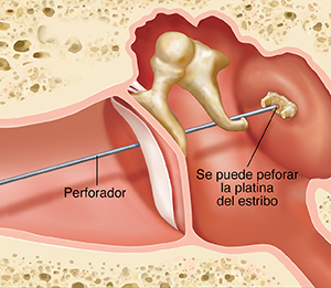 Corte transversal de un oído, donde pueden verse las estructuras del oído externo, interno y medio, con un taladro que hace un orificio en la base del estribo.