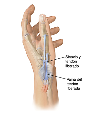 Vista lateral de una mano donde puede verse la vaina cortada sobre los tendones en la base del pulgar para reparar una tenosinovitis de De Quervain.