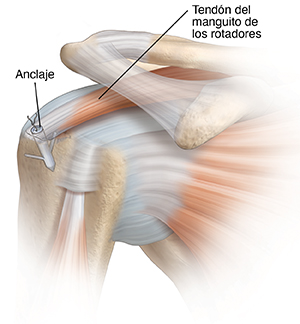 Articulación de hombro que muestra el tendón del manguito de los rotadores con un anclaje