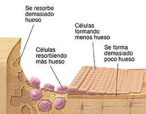 Hueso con osteoporosis que muestra osteoblastos que no producen suficiente cantidad de hueso y osteoclastos que reabsorben demasiado.