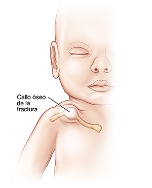 Contorno de un bebé con un callo óseo del la fractura en clavícula.