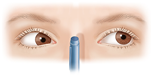 Vista frontal de los ojos de un adulto donde puede verse insuficiencia de convergencia.