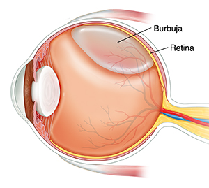 Corte transversal de un ojo donde se observa una burbuja de gas en el vítreo.