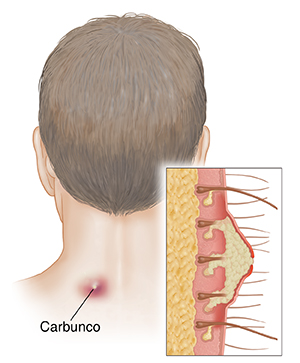 Parte posterior de la cabeza de un hombre donde puede verse un carbunco en su cuello. Recuadro que muestra un corte transversal de un carbunco.
