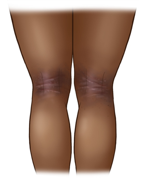 Vista posterior de piernas con dermatitis en los pliegues de las rodillas.