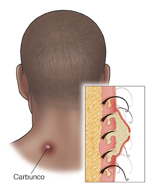Parte posterior de la cabeza de un hombre donde puede verse un carbunco en su cuello. Recuadro que muestra un corte transversal de un carbunco.