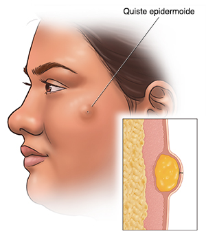 Vista lateral de la cabeza de una mujer en la que se ve un quiste epidermoide. Recuadro que muestra un corte transversal de un quiste epidermoide.