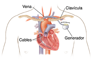 Contorno del pecho de un hombre en el que puede verse un desfibrilador cardioversor implantable colocado con cables que van hacia las cámaras del corazón.