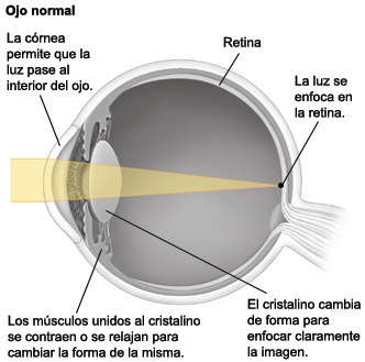 Corte transversal de un ojo donde puede verse la luz que se enfoca en la retina normalmente.