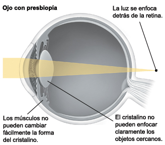 Corte transversal de un ojo donde puede verse la luz que se enfoca detrás de la retina.