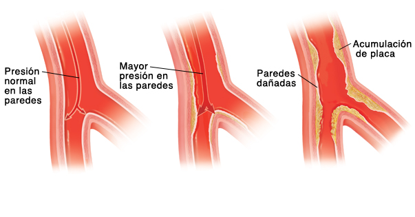 Vaso sanguíneo que muestra una presión normal sobre las paredes arteriales. Vaso sanguíneo que muestra una mayor presión sobre las paredes arteriales. Vaso sanguíneo que muestra paredes dañadas y acumulación de placa.