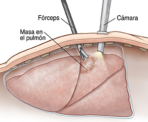 Corte transversal de una pared corporal donde puede verse una cámara insertada en el pecho mientras unos fórceps toman una muestra de una masa en el pulmón.