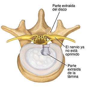 Vista superior de vértebra y disco. Se quitó parte del disco desde el lado posterior, y se quitó parte de la lámina. El nervio ya no está pinzado.