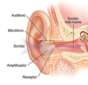Corte transversal de un oído, donde pueden verse las estructuras del oído externo, interno y medio, con un audífono colocado en el conducto auditivo.